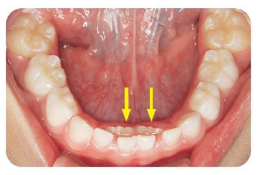 永久歯 内側 から 生える 上 の 歯