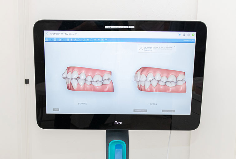 諫早市小野町 たなか歯科医院 iTero