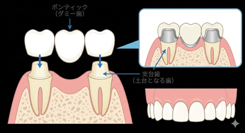 ブリッジ治療の様子