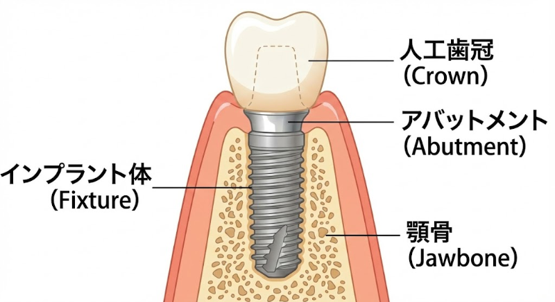インプラントの器具の詳細