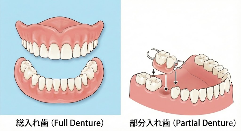 タイプ別の入れ歯